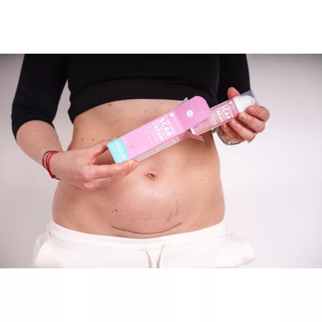 Momcare Császármetszés hegápoló krém 50ml